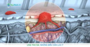 Ung thư da: Những điều cần lưu ý