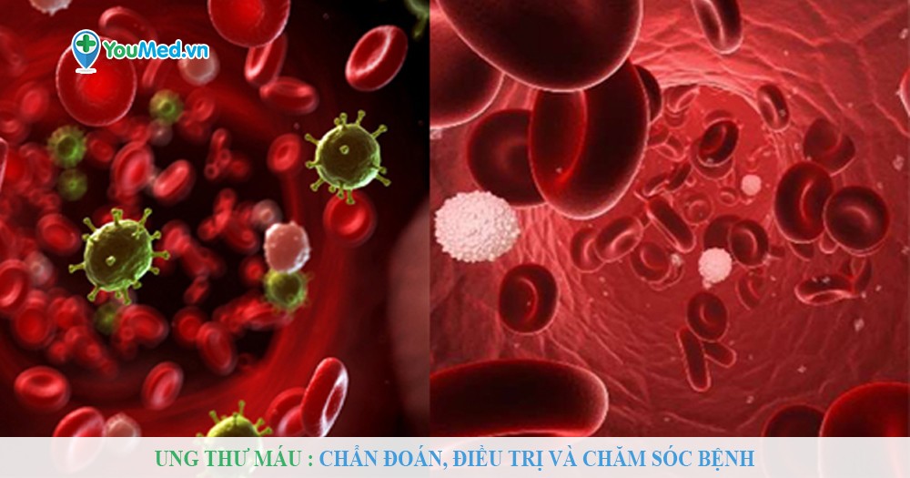 Ung thư máu: Chẩn đoán, điều trị và chăm sóc bệnh
