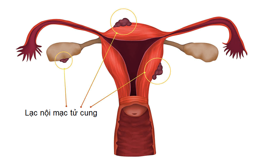Lạc nội mạc tử cung: Chẩn đoán và điều trị - GOTOWOMEN