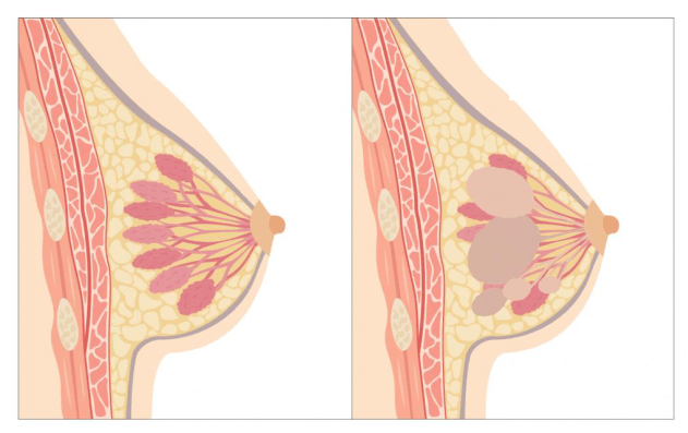 Vú bình thường (bên trái) và thay đổi sợi bọc tuyến vú (bên phải)