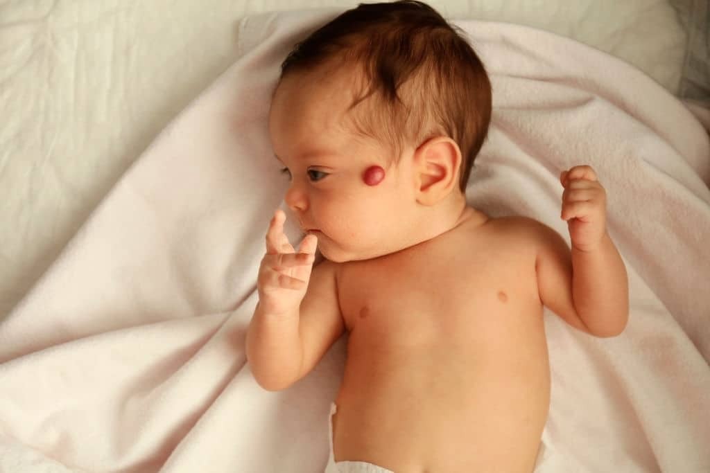Bướu máu ở trẻ sơ sinh là sự tăng sinh của nhiều mạch máu tại một vị trí của cơ thể.