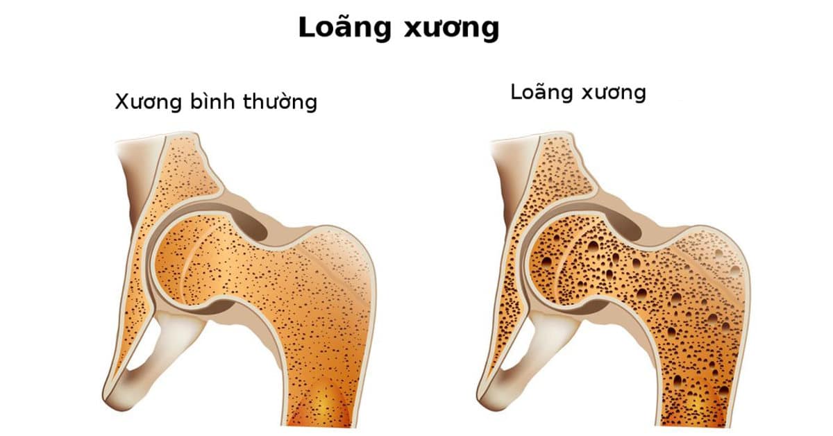 Thuốc Fosamax Plus trị bệnh loãng xương 