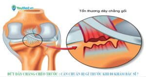 Đứt dây chằng chéo trước : Cần chuẩn bị câu hỏi gì trước khi đi khám bệnh