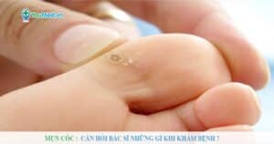 Mụn cóc: Cần hỏi bác sĩ những gì khi khám bệnh?