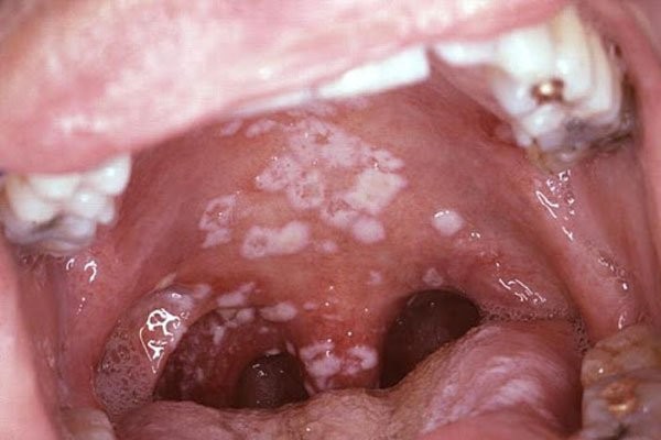 Sang thương mảng trắng điển hình của nhiễm candida hầu họng