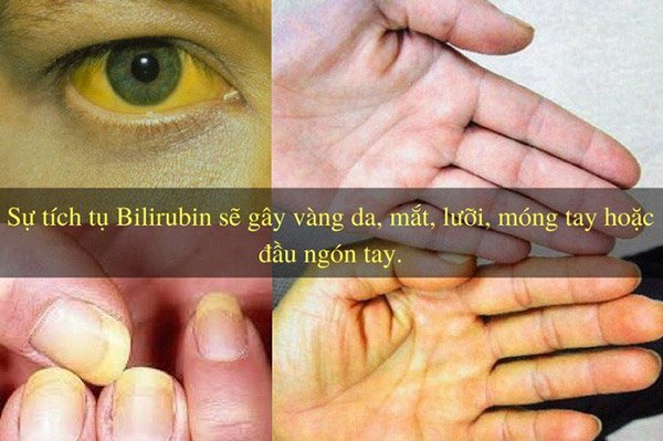 Một số triệu chứng nhận biết khi bị tắc mật