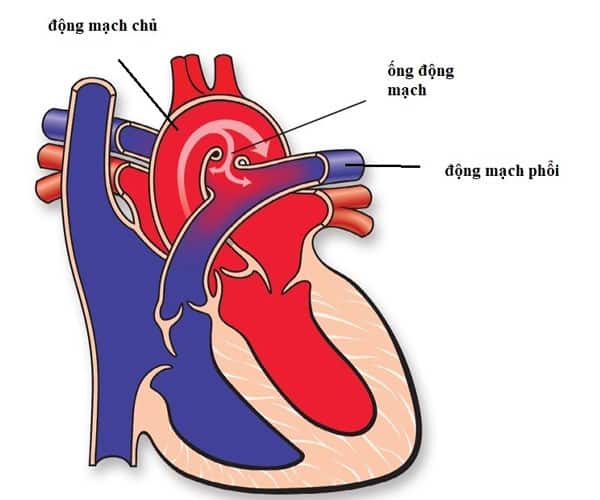 Tim bẩm sinh Còn ống động mạch là bệnh gì?