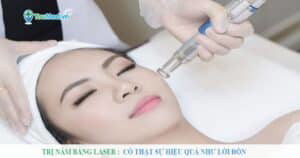 Trị nám bằng laser có thật sự hiệu quả như lời đồn ?