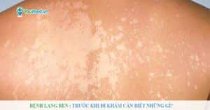 Trước khi khám bệnh Lang ben cần biết những gì?