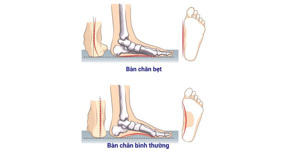 chân bẹt 1