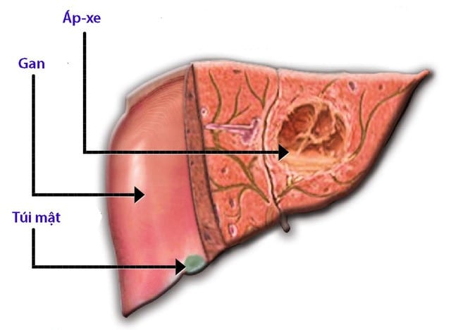 Ổ áp xe là một khối chứa đầy mủ