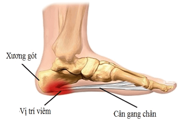 Viêm cân gan chân là nguyên nhân thường gặp nhất của đau gót chân