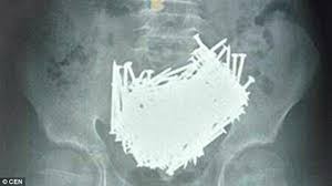 Hình ảnh của một bệnh nhân mắc hội chứng Pica, bệnh nhân ăn đinh và đất đá, đồng xu vào bụng.