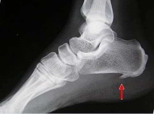Hình ảnh gai gót chân trên X quang