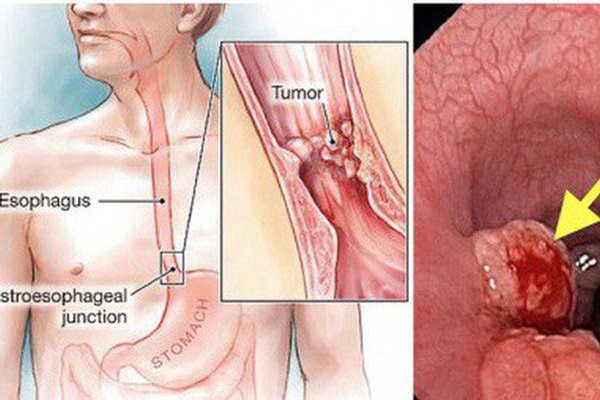 Ung thư thực quản là khối u ác tính của thực quản (esophagus nghĩa là thực quản, tumor nghĩa là khối u)