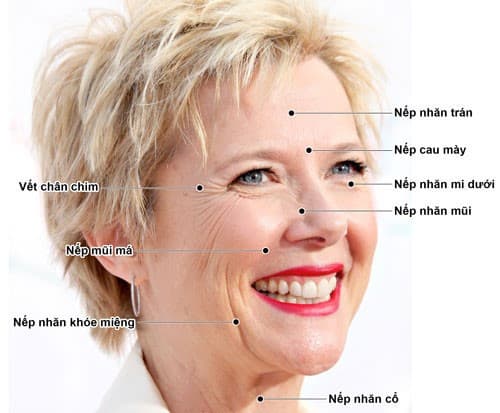 Vị trí nào hay tiêm Botox