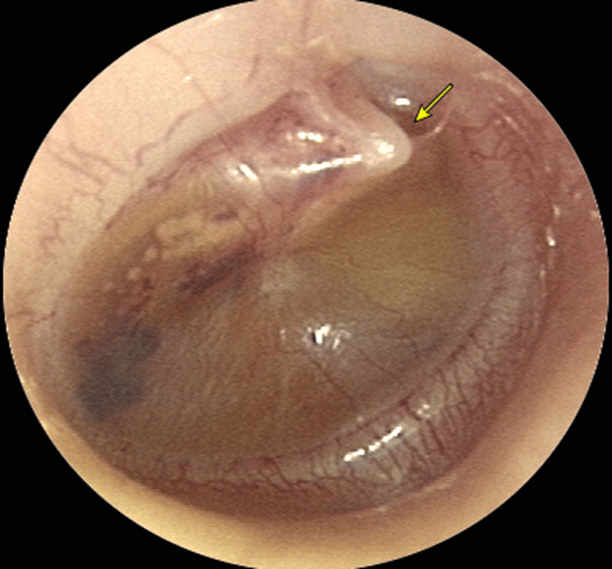 Hình: màng nhĩ phồng với tràn dịch tai giữa có xuất huyết kèm theo