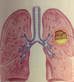 Nhu mô phổi bị hoại tử hình thành khoang chứa mủ 