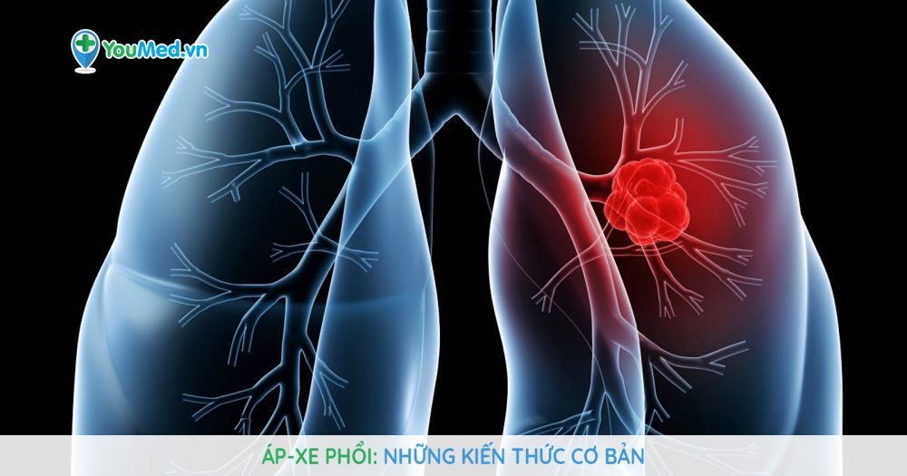 Áp-xe phổi là gì? Nguyên nhân, triệu chứng và cách điều trị