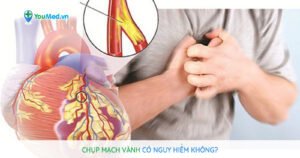 Chụp mạch vành: Có nguy hiểm không?