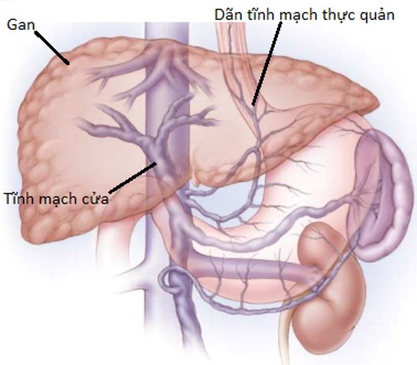 1. Giới thiệu về giãn tĩnh mạch thực quản