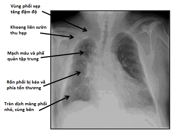 Triệu Chứng và Chẩn Đoán