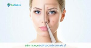 Các cách trị mụn an toàn, khoa học được bác sĩ khuyên dùng