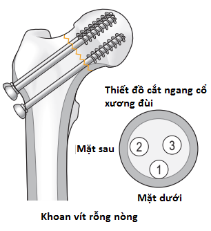 Đóng đinh nối 2 đoạn xương gãy