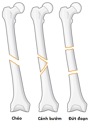 Hình dạng vết gãy xương chân