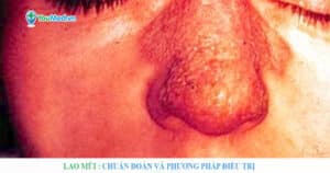 Lao mũi: Chẩn đoán và phương pháp điều trị