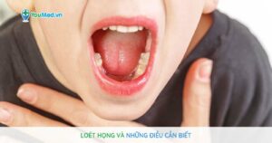 Loét họng: nguyên nhân, biểu hiện và cách điều trị