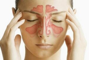 Viêm xoang cấp hay mạn đều có thể gây nghẹt mũi