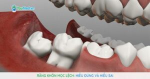 Răng khôn mọc lệch: Hiểu đúng và hiểu sai