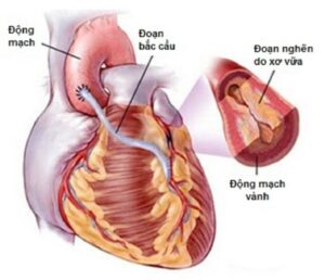 mổ bắc cầu động mạch vành