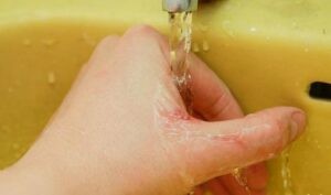 Rửa vết thương ngoài da dưới vòi nước đang chảy là cách đơn giản nhất.