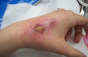 Hình ảnh vết thương ngoài da bị nhiễm trùng