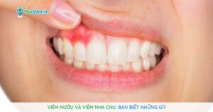 Viêm nướu và viêm nha chu: Bạn biết những gì?