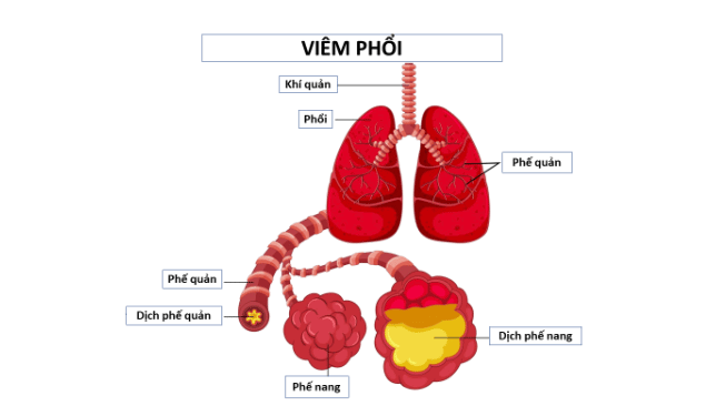 Viêm phổi là gì? Có nguy hiểm không ?