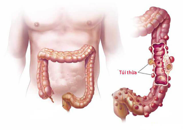 Túi thừa là những túi nhỏ ở ruột, xuất hiện chủ yếu ở đại tràng (ruột già)