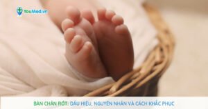 Bàn chân rớt: dấu hiệu, nguyên nhân và cách khắc phục