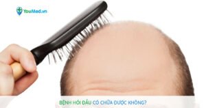 Bệnh hói đầu có chữa được không?