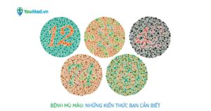 Bệnh mù màu: Những kiến thức bạn cần biết