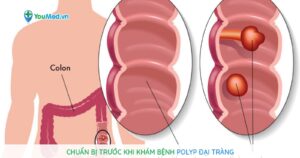 Chuẩn bị trước khi khám bệnh Polyp đại tràng