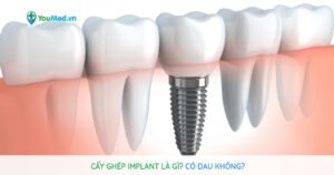 Cấy ghép implant: Quy trình và những điều cần biết