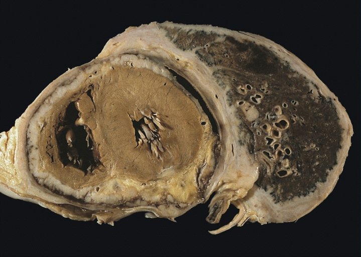 mesothelioma caused by zeolites