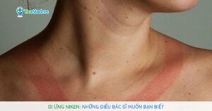 Dị ứng Niken: Những điều bác sĩ muốn bạn biết