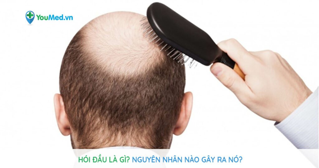 Hói đầu là gì? Nguyên nhân nào gây ra nó?