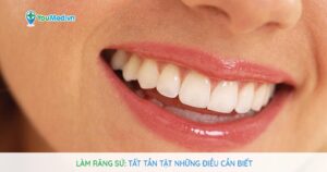 Làm răng sứ: Tất tần tật những điều cần biết