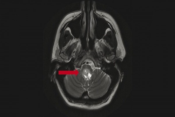 MRI giúp xác định u màng não thất