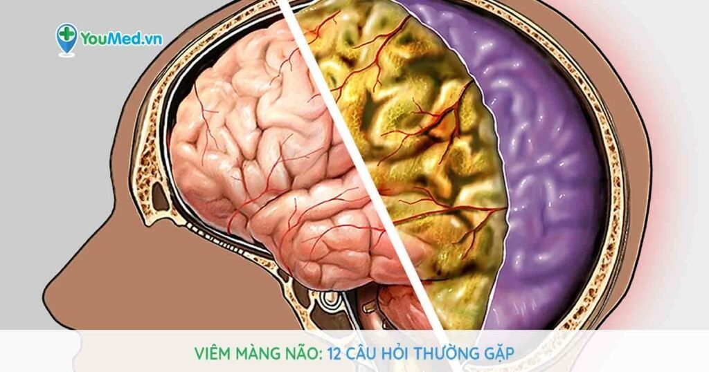 Viêm màng não: Nguyên nhân, triệu chứng và cách điều trị bệnh